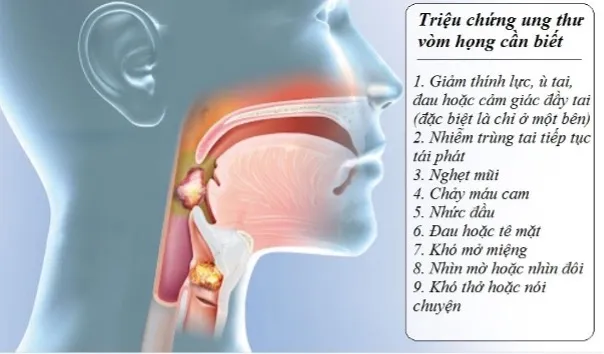 Các triệu chứng nhận biết ung thư vòm họng. Ảnh minh họa: Bệnh viện K ung thư vòm họng