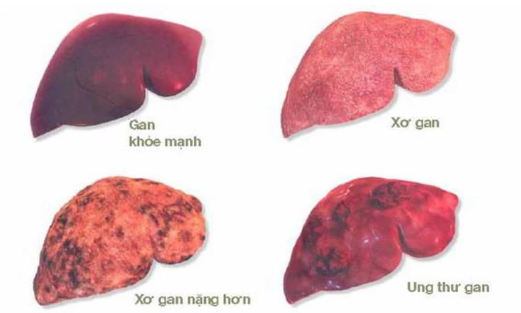 Nên tầm soát ung thư gan 6 tháng một lần để phát hiện sớm bệnh (nếu có). Hình minh họa. nên tầm soát ung thư gan 6 tháng một lần
