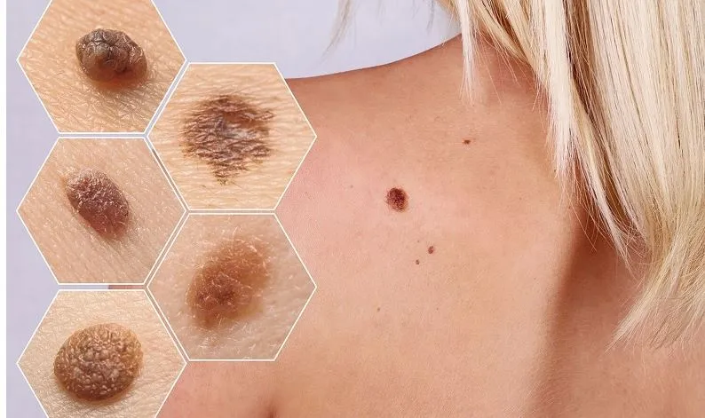 quy tắc abcde kiểm tra ung thư nốt ruồi