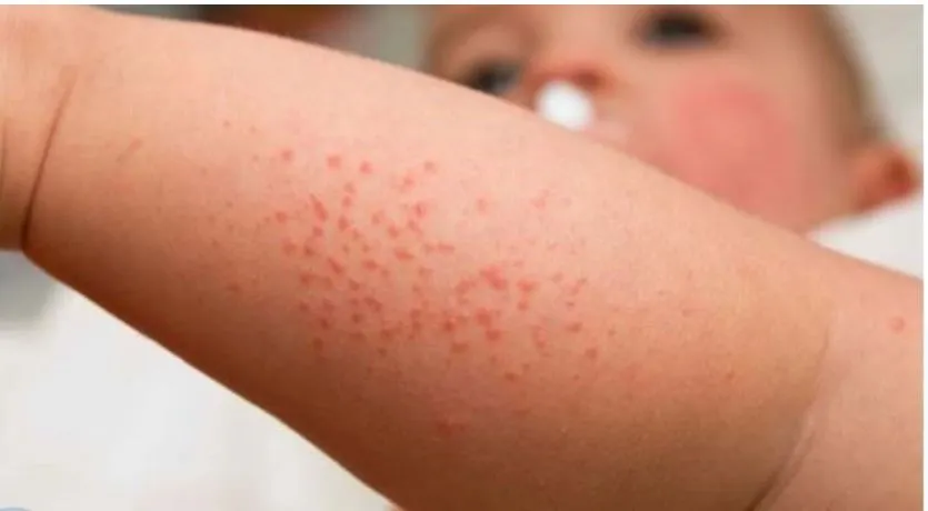 trẻ mắc bệnh sởi có tắm được không