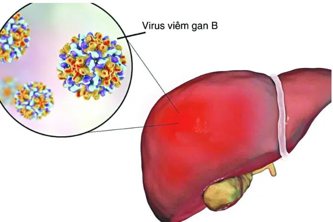 Virus viêm gan B làm tăng nguy cơ tăng sinh tế bào gan ác tính trong suốt thời gian diễn biến viêm gan cho đến xơ gan. viêm gan b dẫn đến ung thư gan