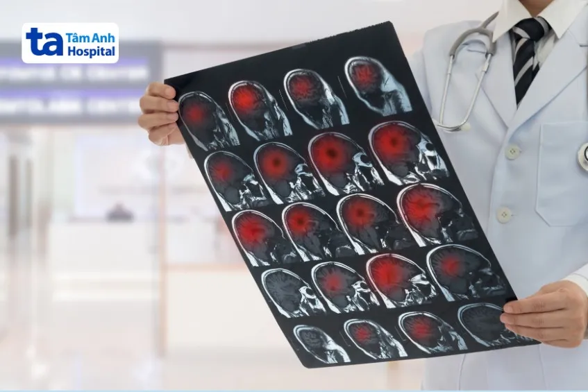 Ung thư não giai đoạn đầu không quá rõ rệt, dễ gây nhầm lẫn với các bệnh lý thần kinh ung thư não
