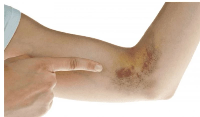 Giảm tiểu cầu là khi tình trạng tiểu cầu trong máu thấp hơn mức bình thường