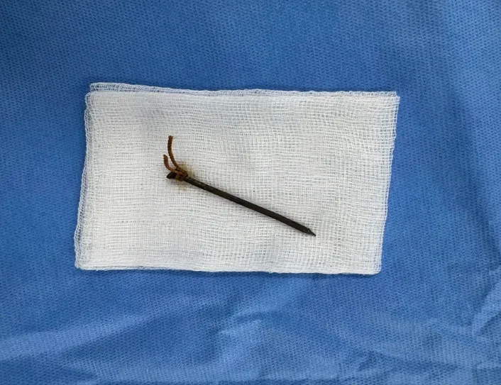 Chiếc đinh sắt cắm sâu vào giữa cổ bệnh nhân