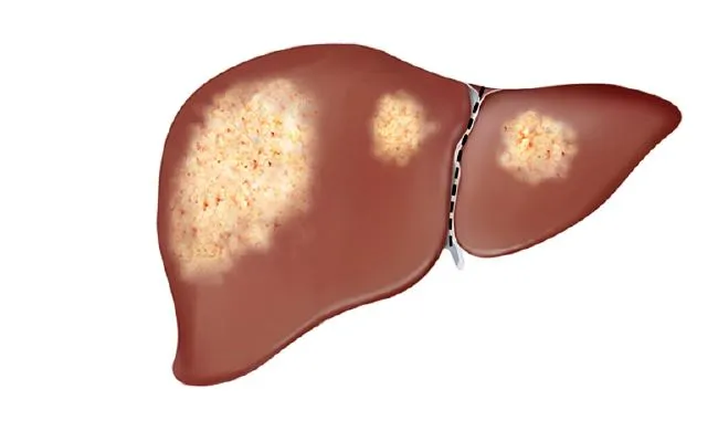 gan nhiem mo do 1.JPG