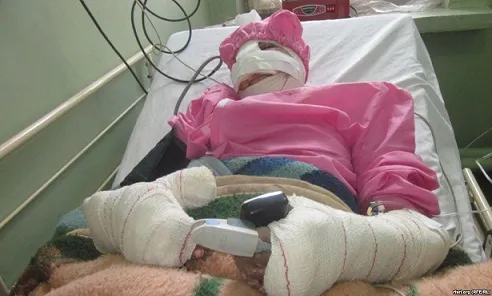 bi-chong-cat-dut-mui-moi-1