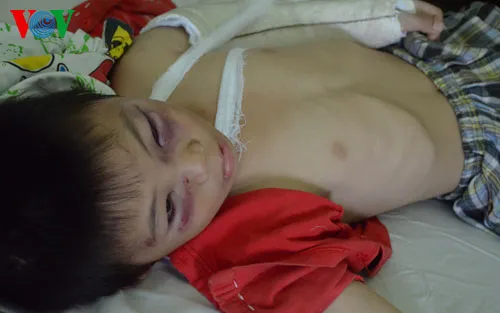 Bé trai bị cha dượng đánh gãy 2 tay chân bị nứt hộp sọ ảnh 1