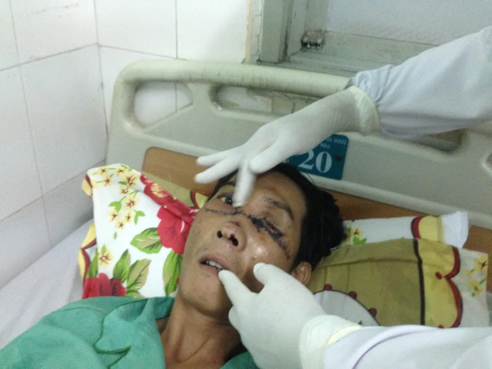 Gãy đôi xương mặt, múc bỏ nhãn cầu trái vì nổ bánh 'xe rùa' ảnh 1 Gãy đôi xương mặt, múc bỏ nhãn cầu trái vì nổ bánh 'xe rùa' ảnh 1