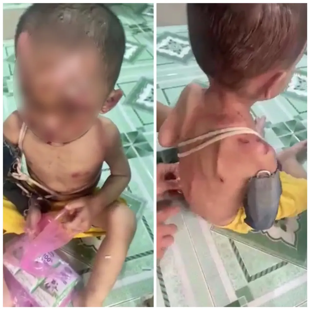 Bé trai với nhiều vết thương trên người. Ảnh cắt từ clip Bé trai với nhiều vết thương trên người. Ảnh cắt từ clip