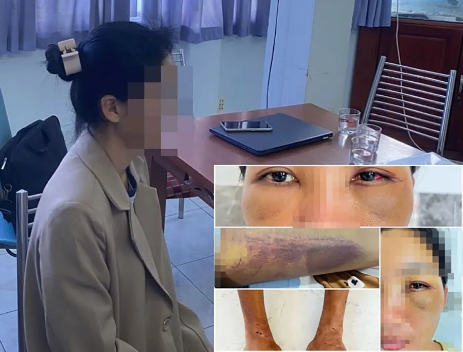 Nạn nhân TTBD bị bạo hành bởi tà đạo "Thiên Triều Nam Quốc' với thương tích khắp nơi, tỉ lệ thương tật 20%. Ảnh: PHÚ NHUẬN. Thiên Triều Nam Quốc