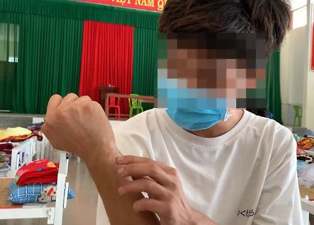 Lê Minh Hoàng (18 tuổi, quê Thái Bình) chỉ những vết thẹo ở tay vì bị những người ở casino Rich World chích điện. Ảnh: HD Lê Minh Hoàng (18 tuổi, quê Thái Bình) chỉ những vết thẹo ở tay vì bị những người ở casino Rich World chích điện. Ảnh: HD