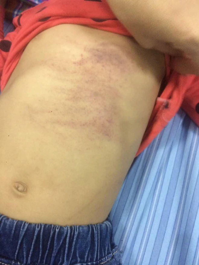 Bé gái bầm khắp người khi từ lớp mầm non về nhà ảnh 1