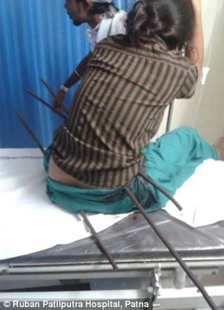 Cô gái bị 3 thanh sắt xuyên thủng người trong 10 tiếng đồng hồ ảnh 1