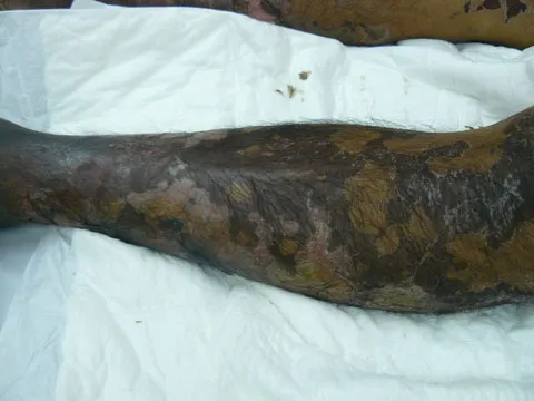 Chân bệnh nhân nhiễm liên cầu khuẩn lợn. Ăn tiết canh lợn: Sướng một lần, mất một đời