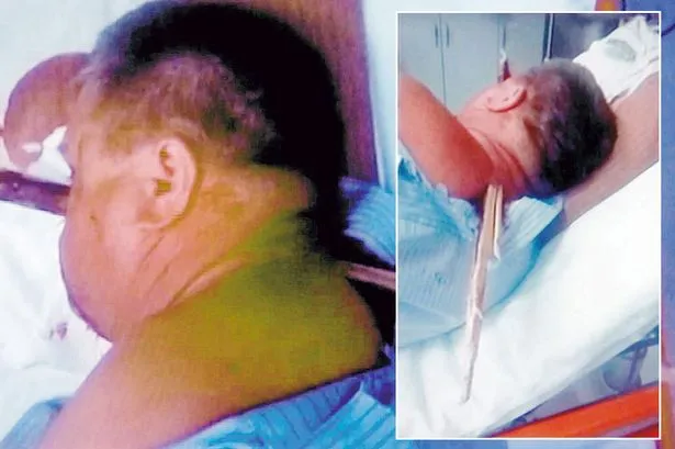 Bị cọc gỗ 38cm đâm xuyên đầu … vẫn sống sót ảnh 1