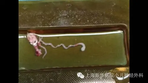 Sán dài 8 cm làm tổ trong não vì thức ăn đường phố ảnh 1 Sán dài 8 cm làm tổ trong não vì thức ăn đường phố ảnh 1