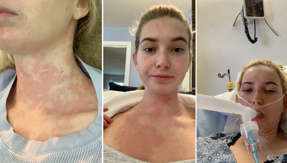 Hội chứng kích hoạt tế bào mast_3.jpg