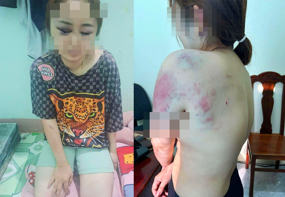 Người phụ nữ bị chồng hờ bạo hành đến nhập viện ở huyện Ngọc Hồi, Kon Tum