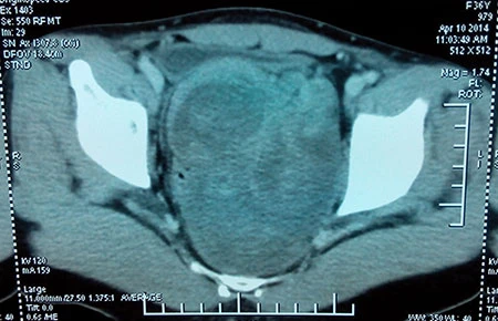 Mổ bóc khối u lớn trước xương cùng cụt hiếm gặp ảnh 1