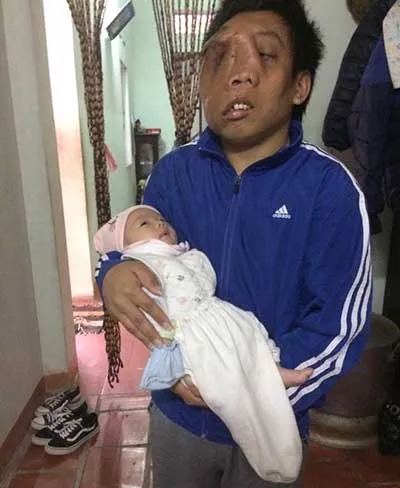 Người đẹp khuyết tật và chàng trai có khối u che mặt ảnh 3 Người đẹp khuyết tật và chàng trai có khối u che mặt ảnh 3