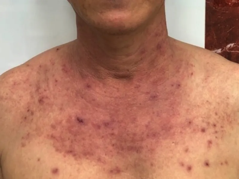 Cảnh báo nhiều bệnh khi trời nắng gay gắt ảnh 2 Cảnh báo nhiều bệnh khi trời nắng gay gắt ảnh 2