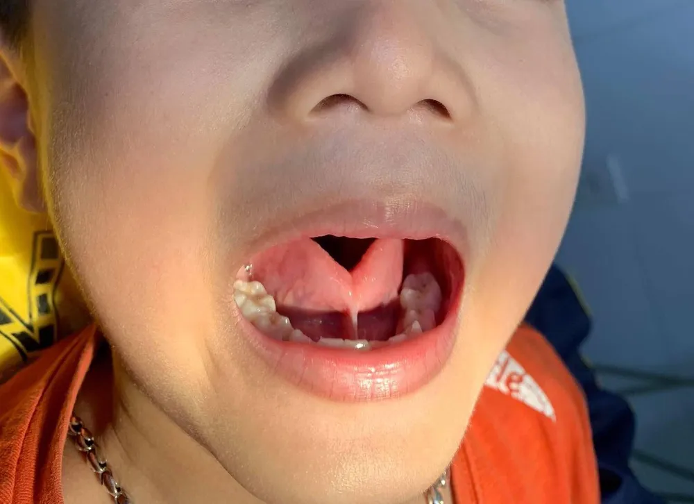 Trẻ 4 tuổi chưa biết nói vì bị dính thắng lưỡi ảnh 2 Trẻ 4 tuổi chưa biết nói vì bị dính thắng lưỡi ảnh 2