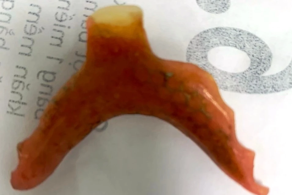 Các bác sĩ lấy chiếc răng giả mắc trong thực quản bệnh nhân ra ngoài. Ảnh: TN