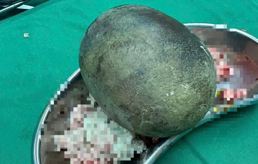 Sỏi bàng quang.jpg