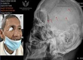 Đề xuất tăng mức quà tặng cho người có công dịp 27-7 ảnh 2 Sắp gắp ra hàng trăm mảnh đạn trong đầu bác thương binh