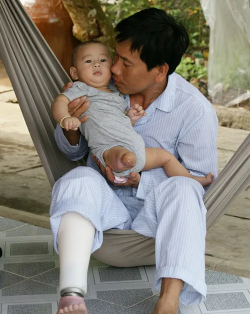 Bé văng ra khỏi bụng mẹ tập đi với chân giả ảnh 4