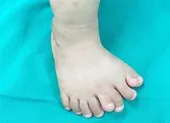 Hy hữu: Bé trai Thanh Hóa có 9 ngón trên 1 bàn chân 