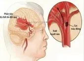Nhiễm COVID-19 khiến nguy cơ đột quỵ cao gấp 7 lần ảnh 1 Phân loại các dạng đột quỵ