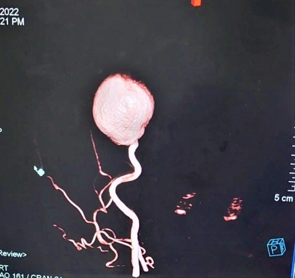 Cứu sống bệnh nhân phình động mạch “khổng lồ” ảnh 1