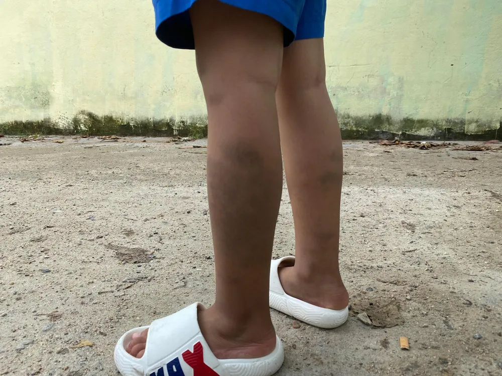 Đến sáng nay, hai chân của cháu H vẫn còn vết bầm. Ảnh: Hải Hiếu Đến sáng nay, hai chân của cháu H vẫn còn vết bầm. Ảnh: Hải Hiếu