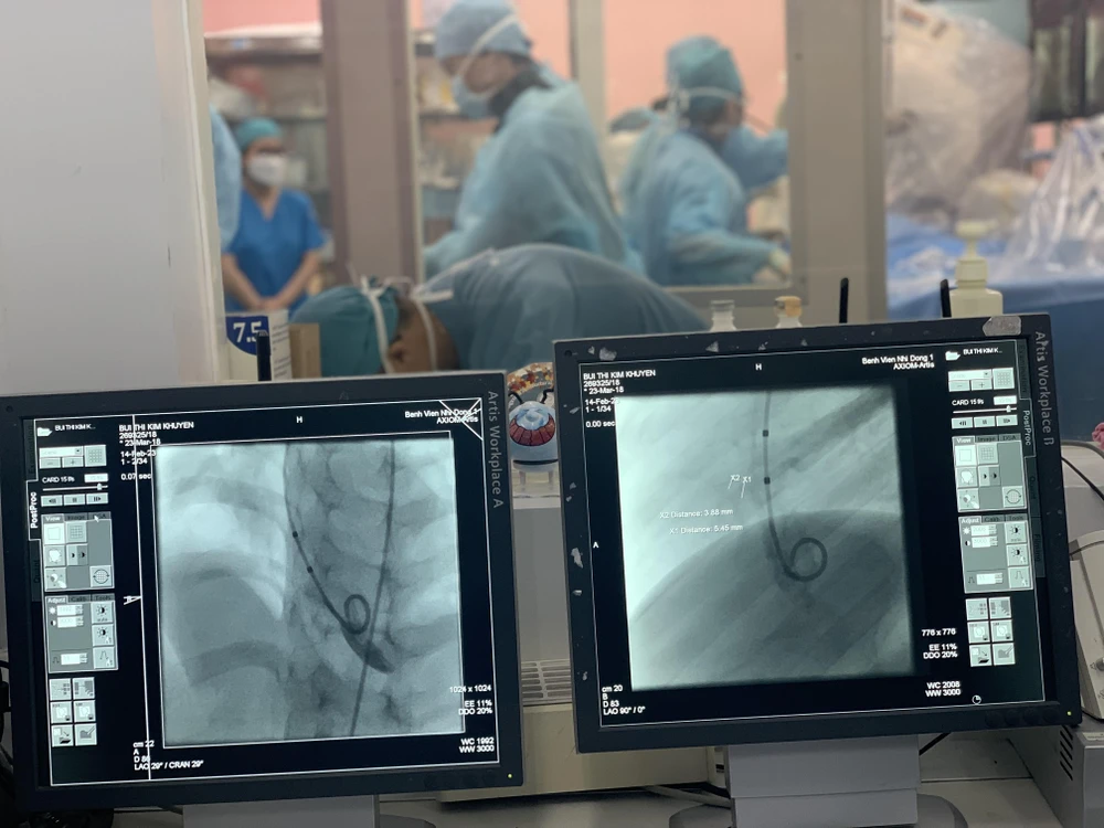 Hình ảnh dụng cụ thông tim được luồn vào sửa chữa dị tật tim.