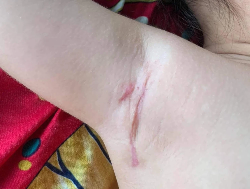 Đường mổ tim ít xâm lấn nhỏ chỉ khoảng 3 cm ở nách phải.