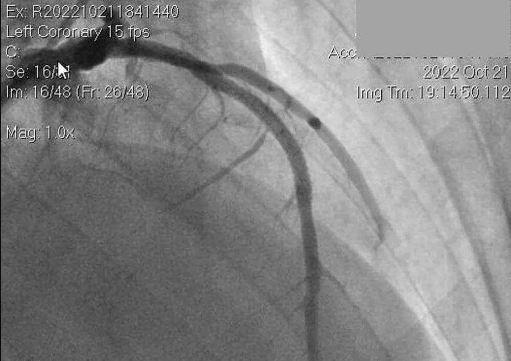 Hình ảnh chụp mạch máu của bệnh nhân THT. Ảnh: BVCC Hình ảnh chụp mạch máu của bệnh nhân THT. Ảnh: BVCC