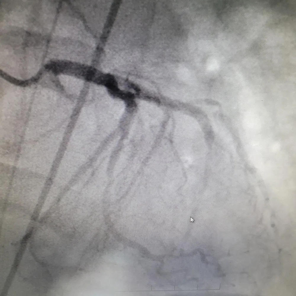 Hình ảnh chụp đông mạch vành của bệnh nhân sau can thiệp. Ảnh: BVCC