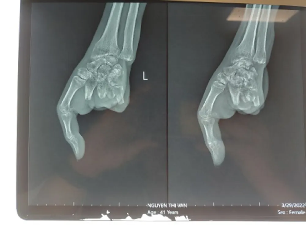 Hình chụp X-quang bàn tay trái trước khi nối ngón. Ảnh: BVCC Hình chụp X-quang bàn tay trái trước khi nối ngón. Ảnh: BVCC