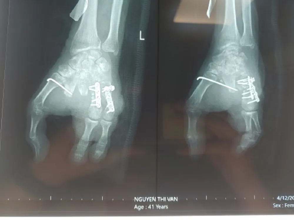 Hình chụp X-quang bàn tay trái sau khi nối ngón. Ảnh: BVCC Hình chụp X-quang bàn tay trái sau khi nối ngón. Ảnh: BVCC