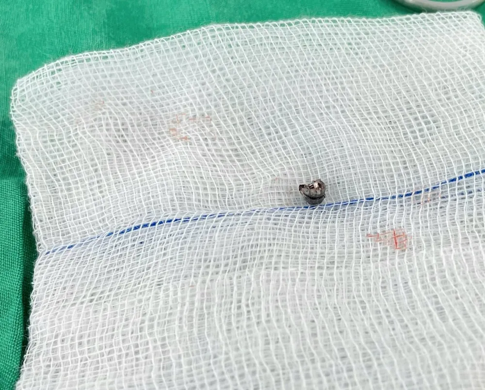 Dị vật là viên đạn chì kích thước 5 mm. Ảnh: BVCC