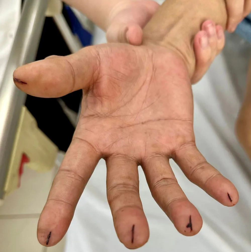 Các đầu ngón tay bị cắt bởi dao lam. Ảnh: Bác sĩ cung cấp