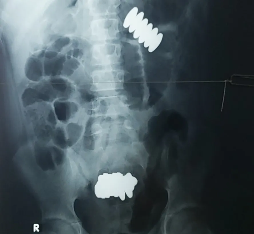Hình chụp X quang phát hiện có hai khối dị vật bên trong. Ảnh: BVCC Hình chụp X quang phát hiện có hai khối dị vật bên trong. Ảnh: BVCC
