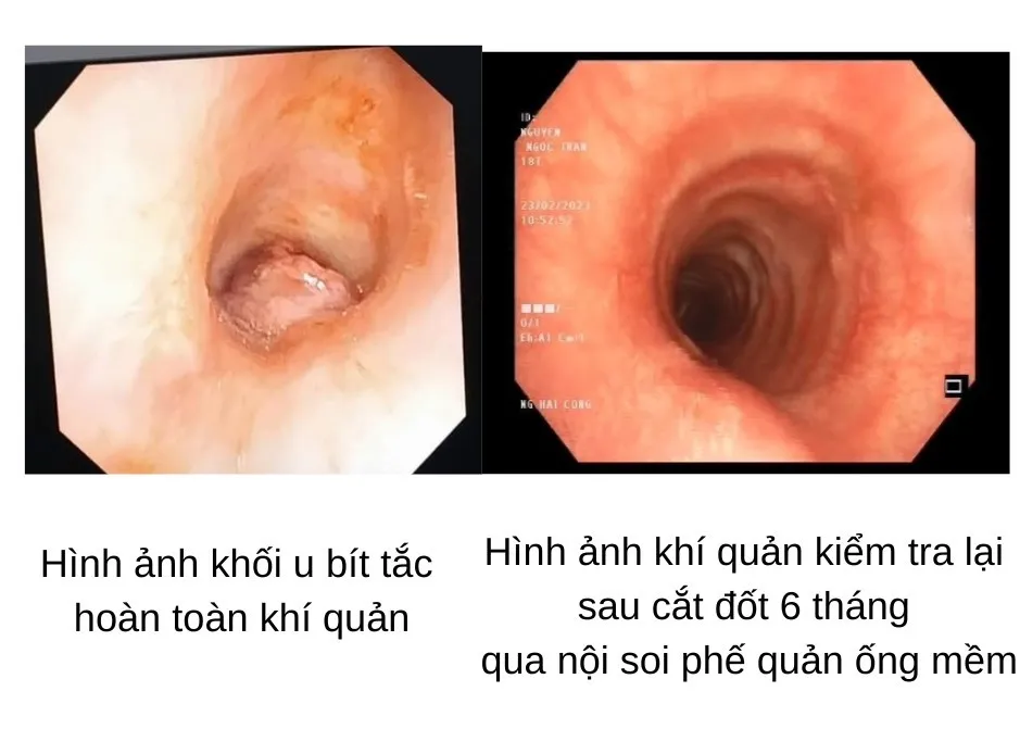 Hình ảnh khối u trước và sau cắt đốt. Ảnh: BVCC