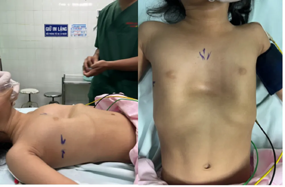 Bé gái 3 tuổi bị lõm ngực nghiêm trọng. Ảnh: BVCC Bé gái 3 tuổi bị lõm ngực nghiêm trọng. Ảnh: BVCC