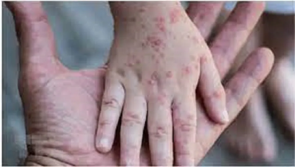 Khuyến cáo nhận biết triệu chứng nghi ngờ đậu mùa khỉ, kịp thời điều trị. Ảnh: Internet đậu mùa khỉ - 4