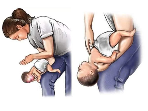 Thủ thuật vỗ lưng, ấn ngực dành cho trẻ dưới 2 tuổi bị hóc dị vật đường thở. Ảnh: Internet dị vật đường thở - 1