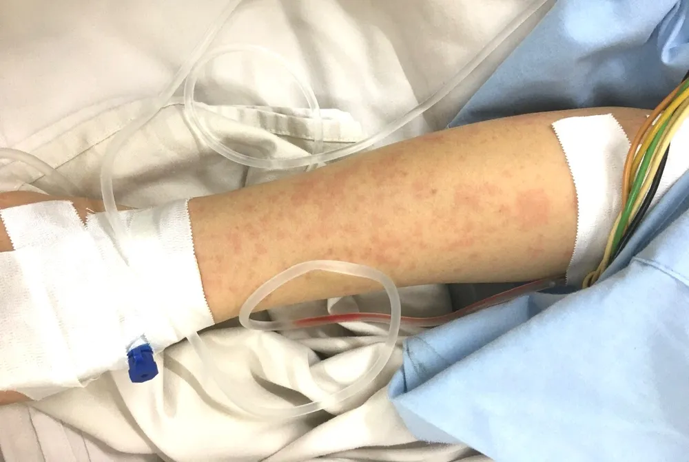 phản vệ độ 3 - 1