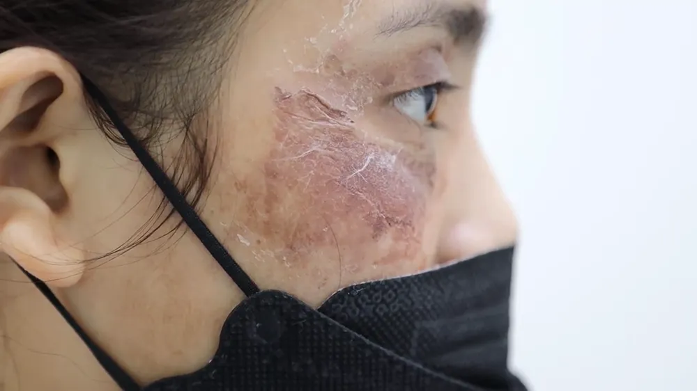 Một bệnh nhân khác cũng bị tai biến sau peel da tại nhà. Ảnh: BVCC peel da tại nhà - 1