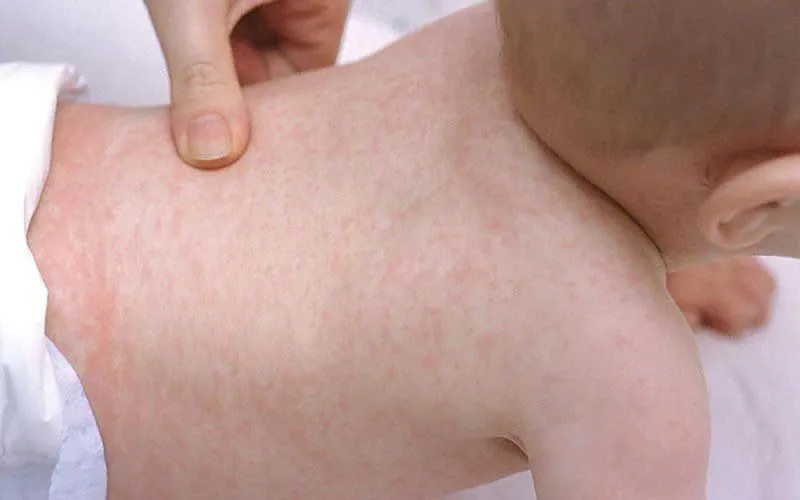 Khởi đầu bệnh, trẻ có thể có các triệu chứng như sốt, ho, sổ mũi. sốt siêu vi - 1
